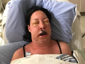 'She's lucky': Alberta woman recovering after losing lip to flesh-eating disease